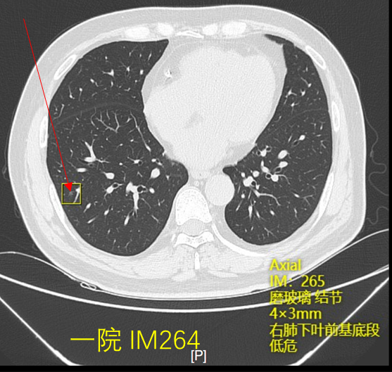 如何判定两次ct出现的肺结节是否同一个真实案例分享与探讨