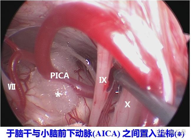 3月14日,王景博士为进行了显微血管减压手术,术中将面神经根与责任