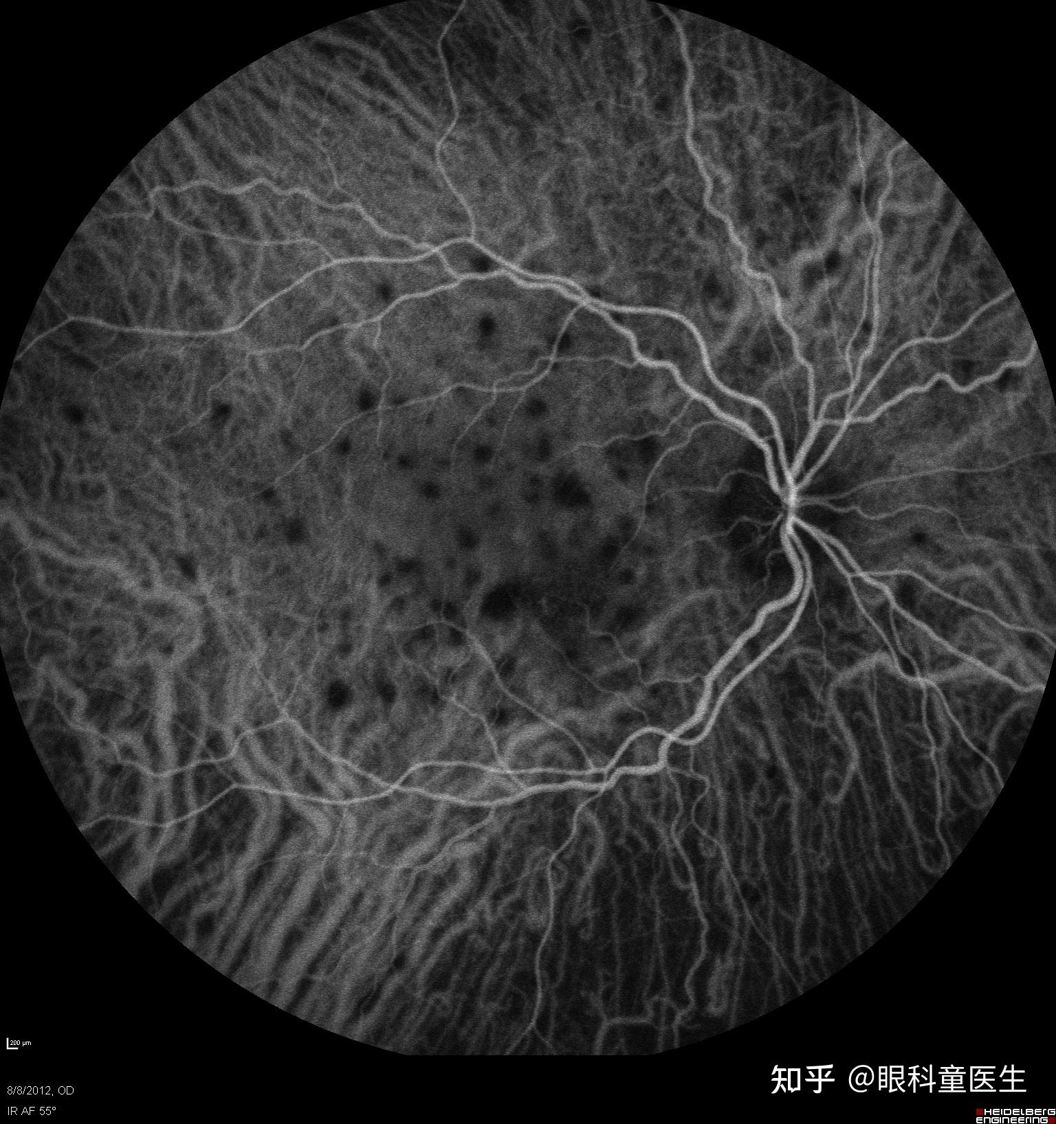 脉络膜透见图片