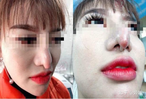 又一个姐妹隆鼻失败了!想在上海隆鼻该如何避坑?