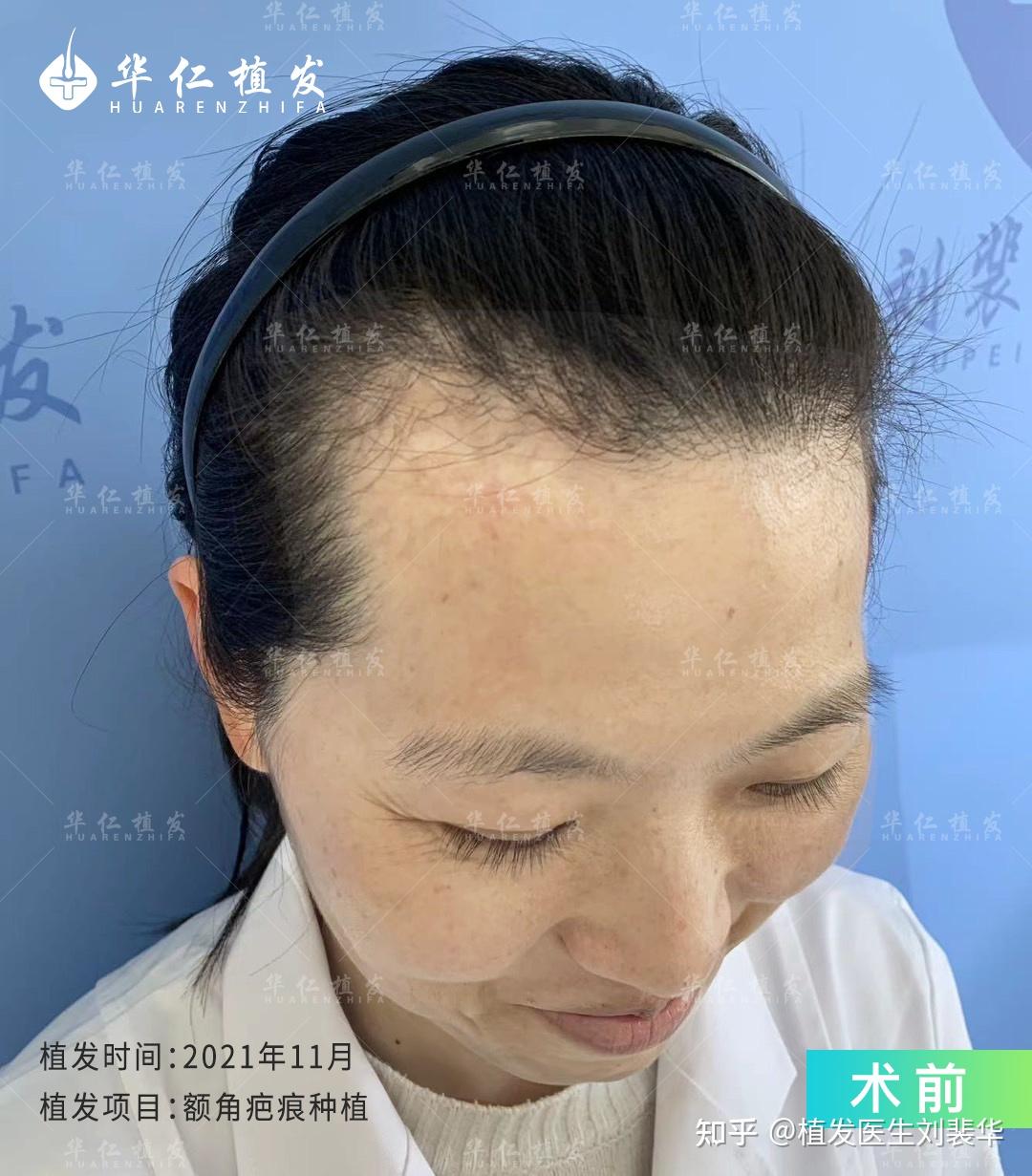 疤痕植发效果怎么样? - 知乎