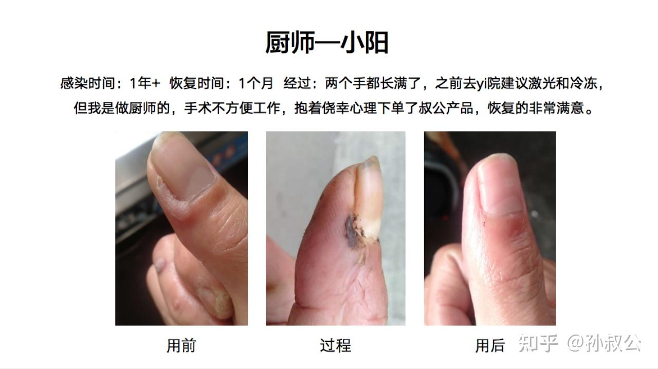 多颗跖疣20实例一招分清刺瘊鸡眼扁平疣详图版