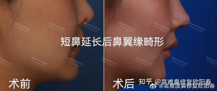 怎么纠正鼻翼缘退缩? - 知乎