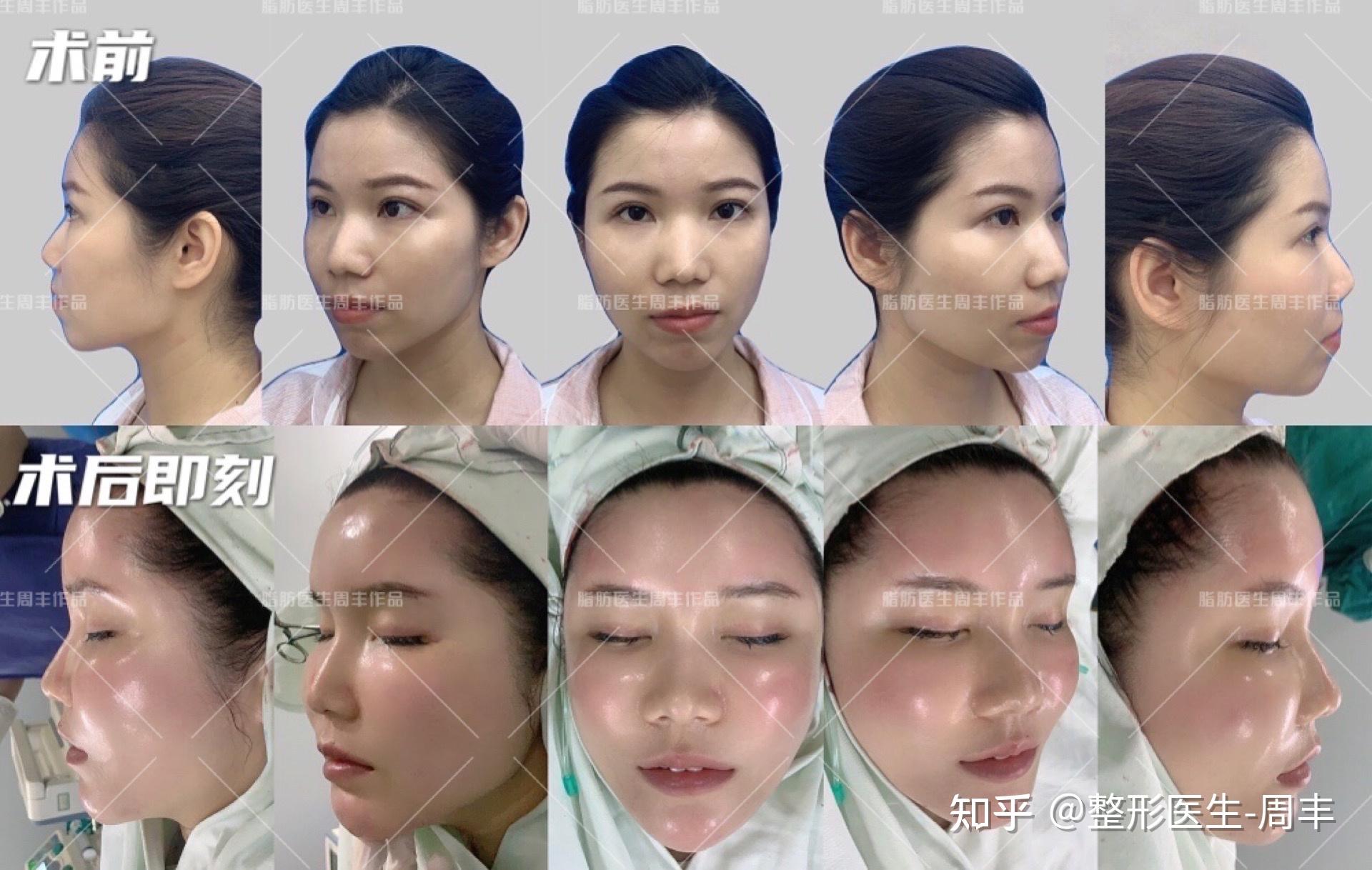 面部年轻化有什么方法建议收藏