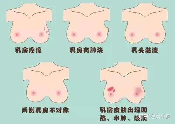刘燕酿制女性如何进行胸部自检