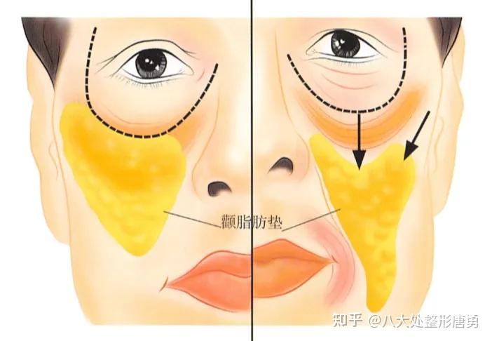 面部凹陷是初老的表现,为什么会出现面部凹陷?凹陷的脸该如何回到从前? - 知乎