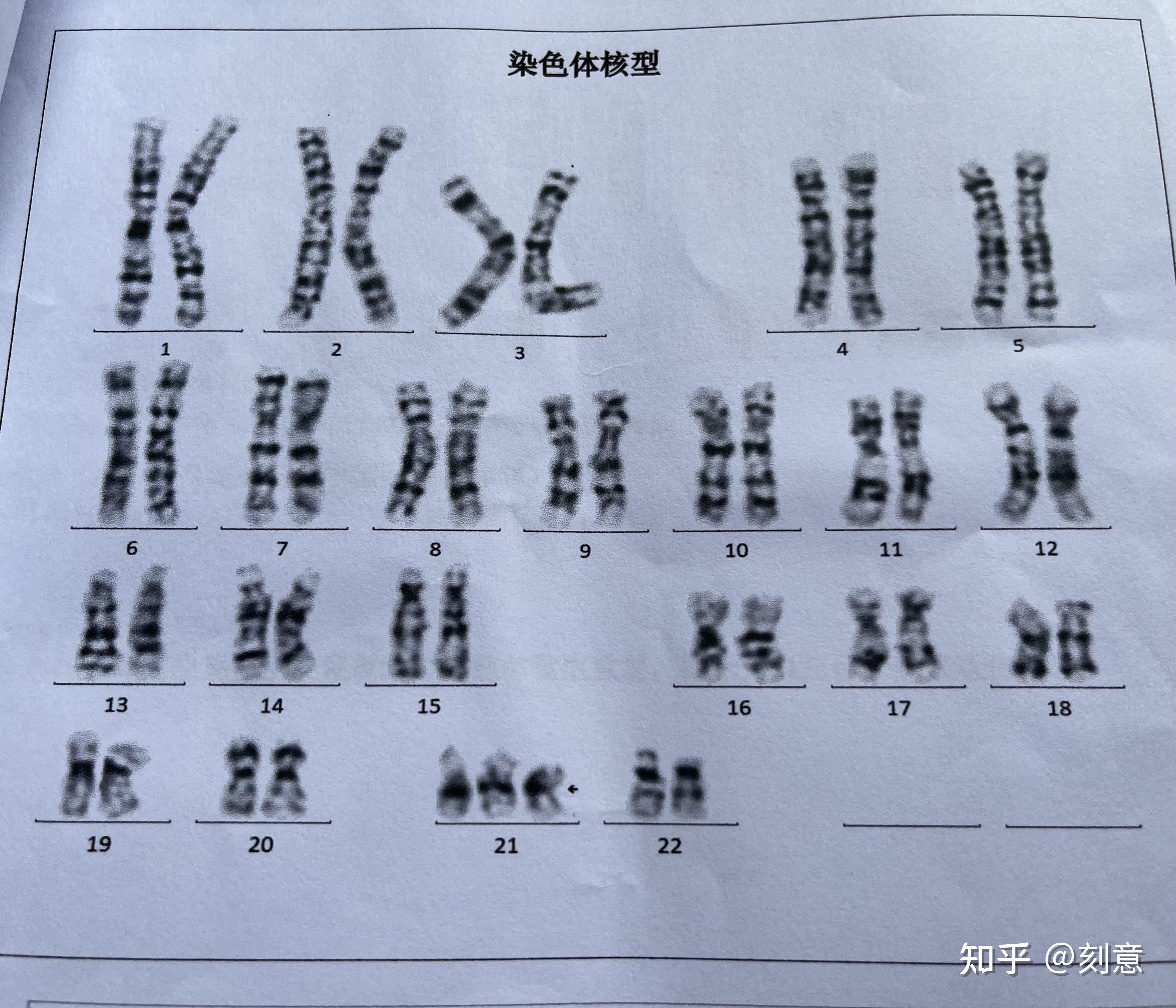 無創dna21高風險數值23羊穿到引產全過程