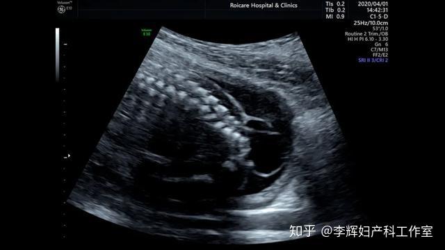 胎儿期发现脊髓圆锥位置低的临床指导