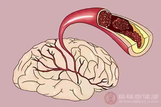 简单认识一下脑梗中风脑栓塞