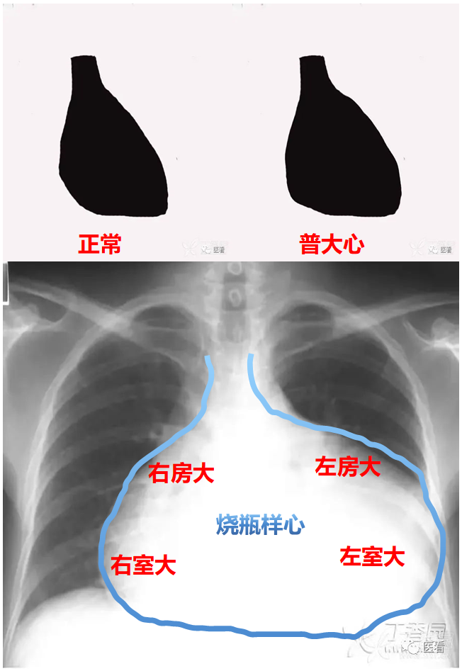 正常、异常心形 - 知乎