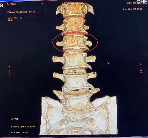 朱医生的患者故事 腰椎骨折