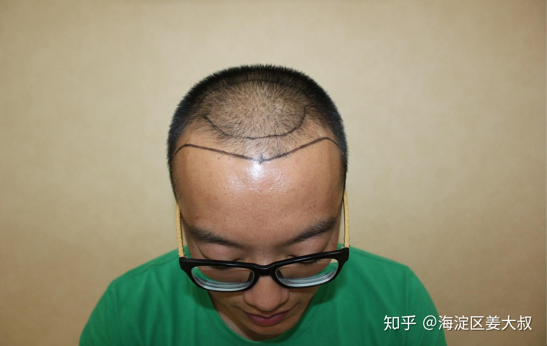 【经验】植发效果怎么样？植发恢复期过程全纪录 - 知乎
