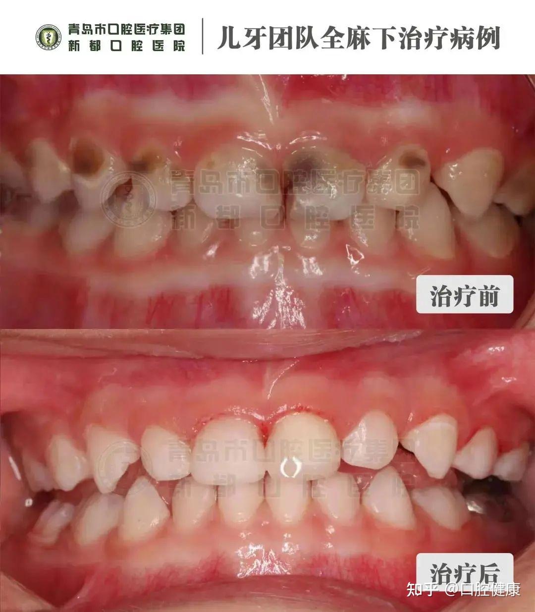 寶媽們一定注意兒童蛀牙更多發生在這顆牙上六齡齒