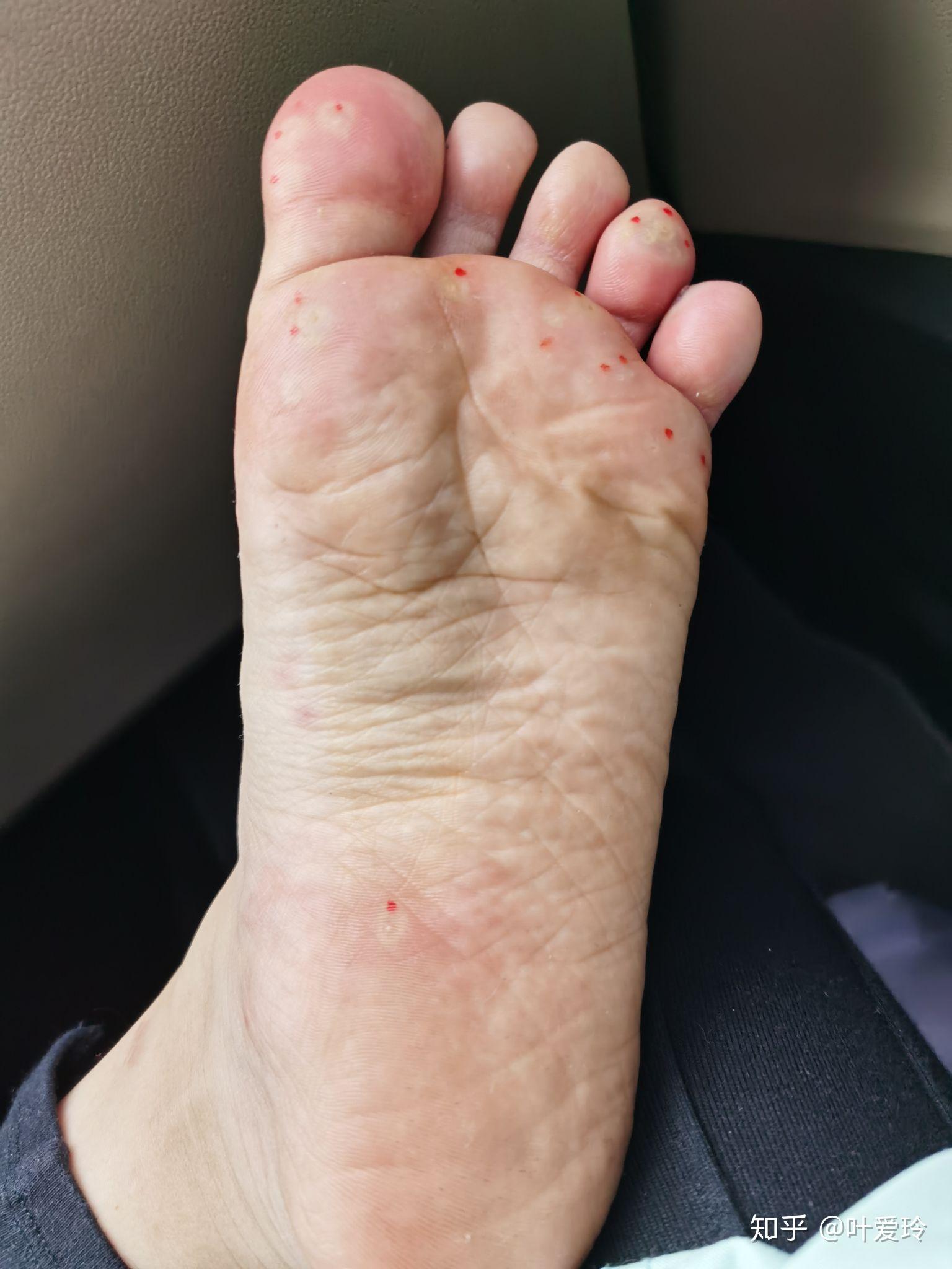 3月18日早上泡完硼酸,涂人工干扰素.母疣中间已经看到黑色的丝.