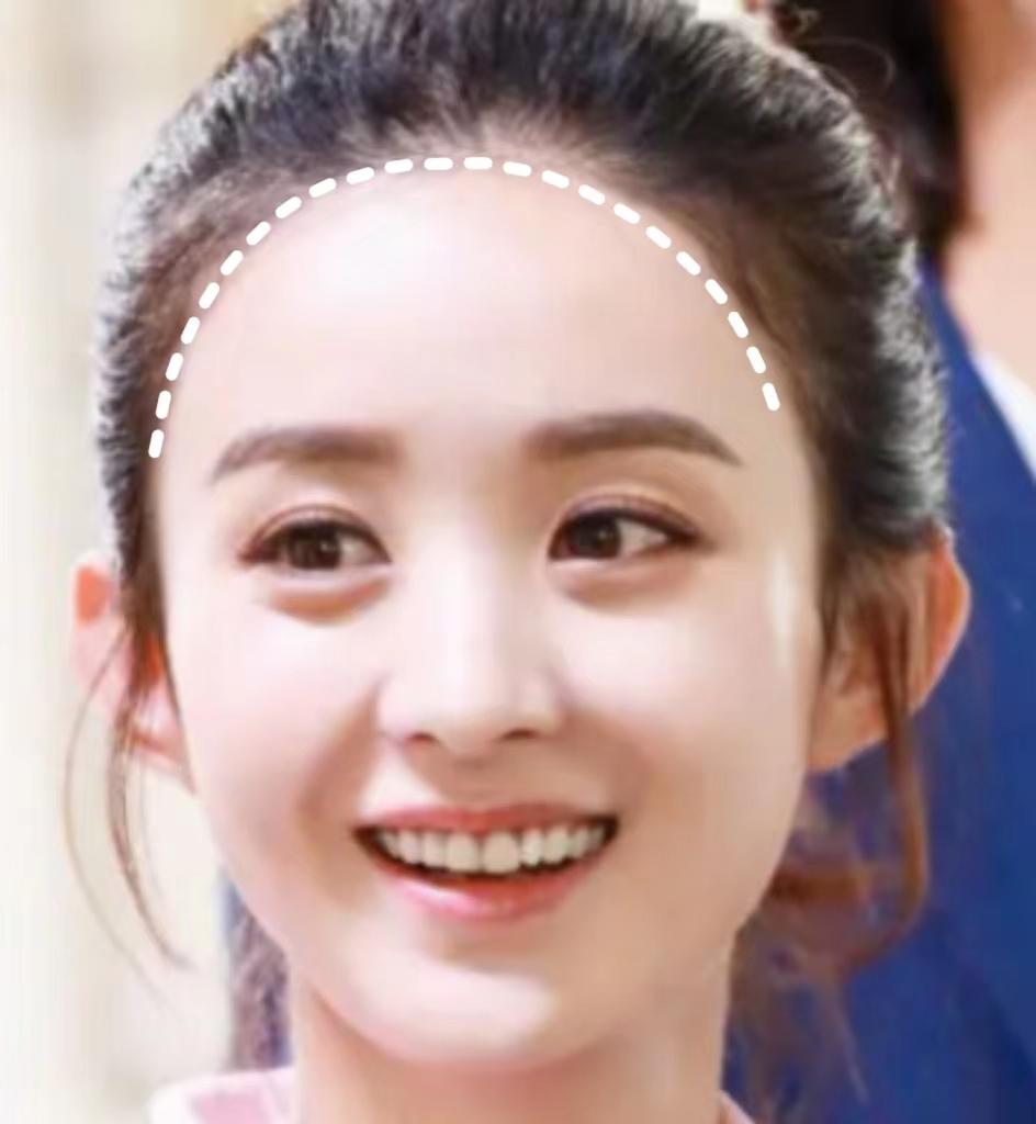 植发选什么发际线形状形状决定是否能改善脸型不适合的形状反向植发