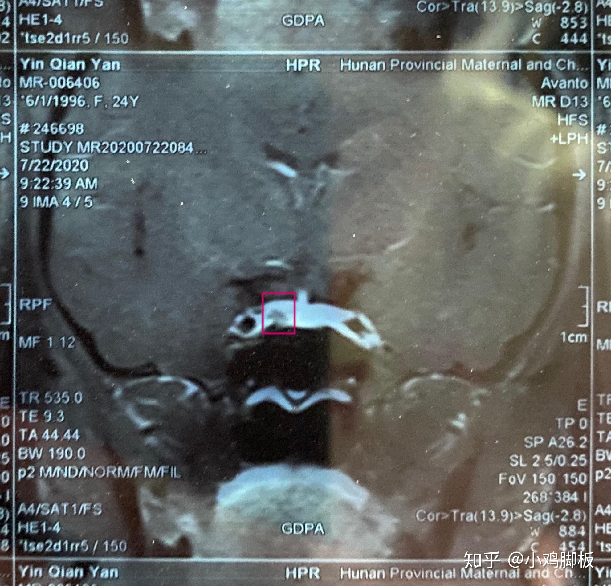 颅脑解剖之鞍区病变影像|腺瘤|垂体|结构|动脉瘤|垂体瘤|-健康界