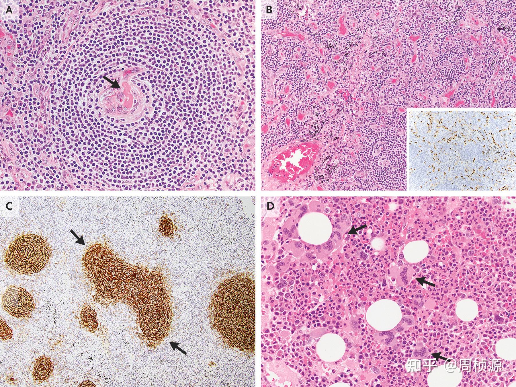 复查外院前纵隔肿物和淋巴结组织切片.