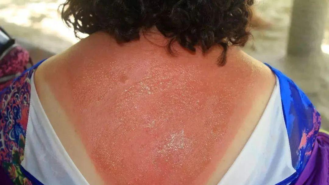 比皮肤发红,肿痛更严重的晒伤程度就是皮肤开始脱皮皮肤感觉灼热,刺痛