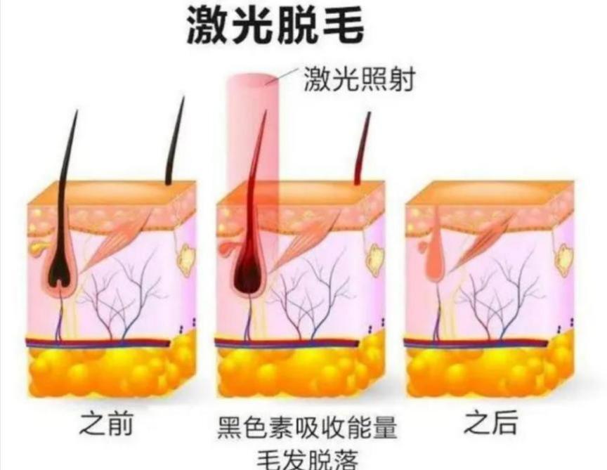 一,激光脱毛的原理