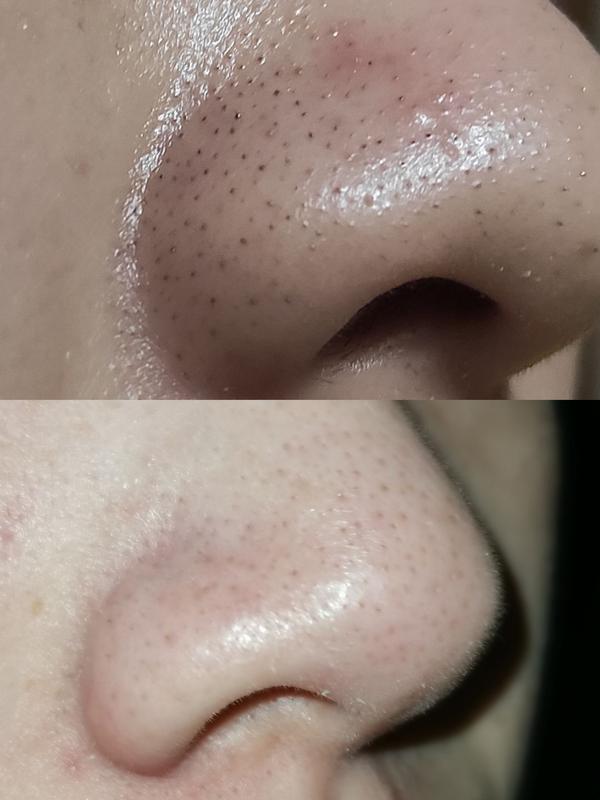 我鼻子长满了黑头,像草莓籽扎堆一样,能挤出来黄色的,超级恶心,求推荐