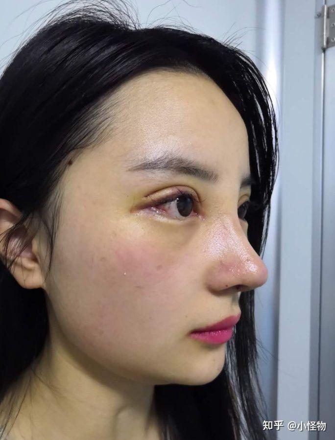 上海九院隆鼻哪些医生比较好戴传昌鼻综合隆鼻怎么样