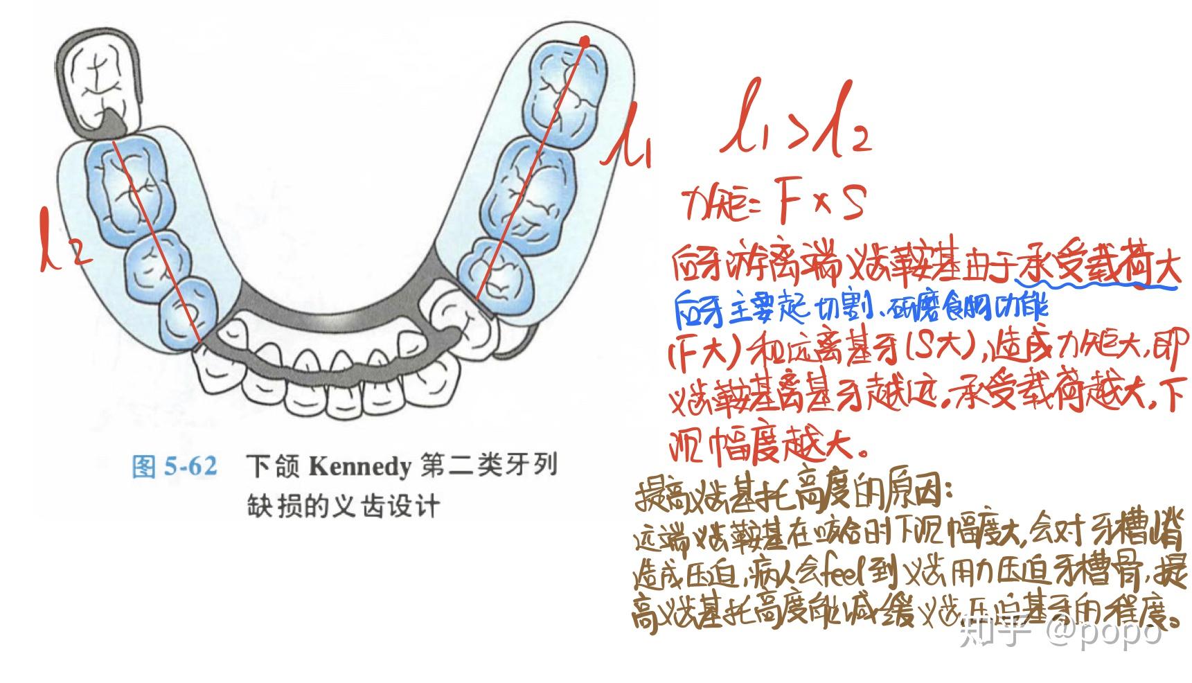 可摘局部義齒中印模的分類及其適應證