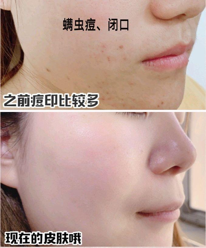 拒绝"螨虫脸"!5秒揉一揉,螨虫全出来了,痘痘黑头全没了! - 知乎