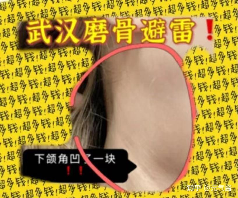 下颌角颧骨失败反馈北京上海成都广州武汉磨骨医生应该避开有哪些