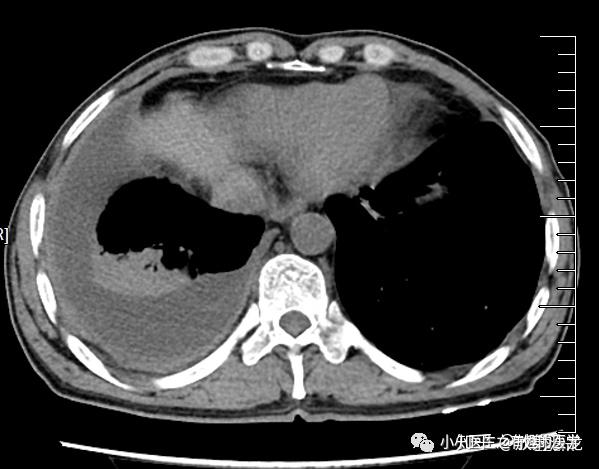 有趣病例游走的胸腔积液