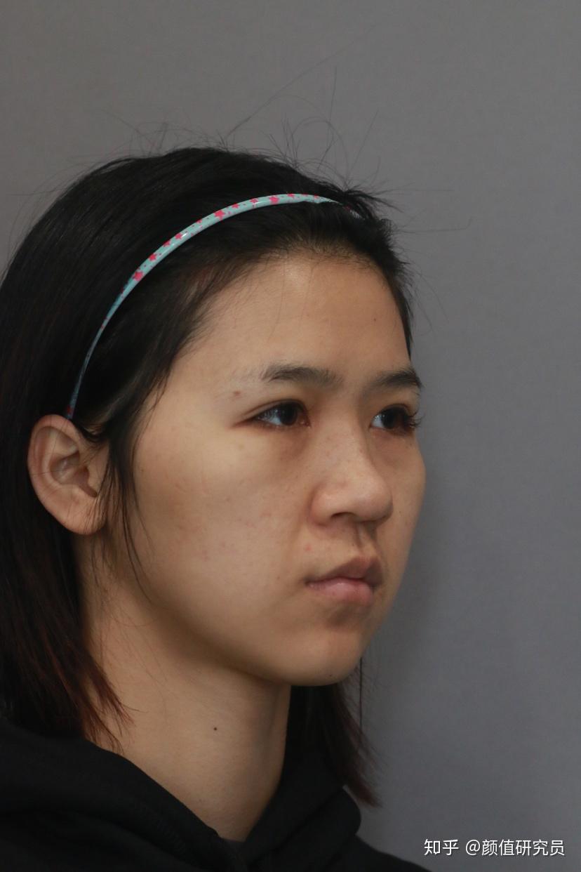 鼻子很挺但是鼻翼很大是什么体验