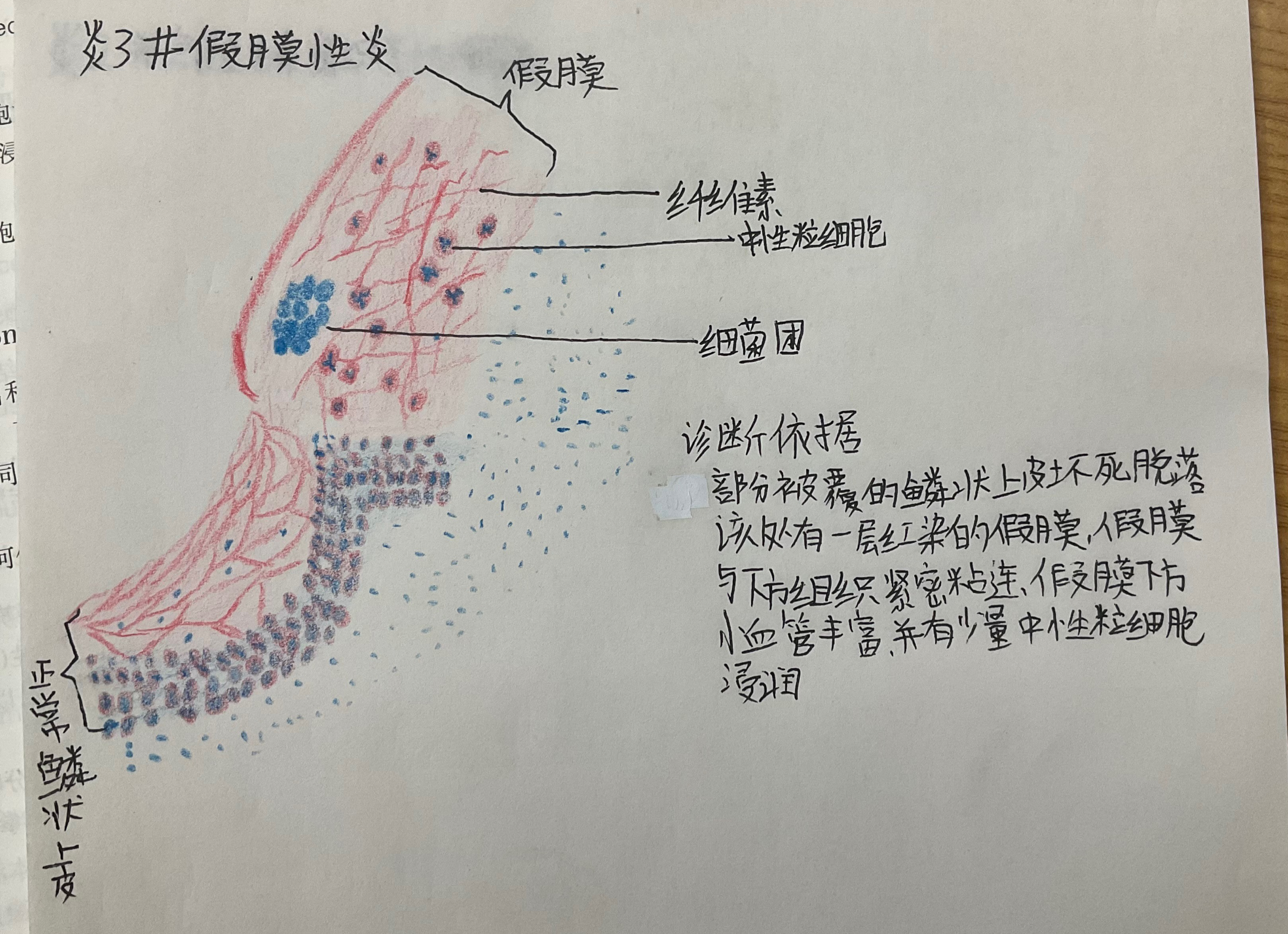 慢性阑尾炎红蓝铅笔图图片
