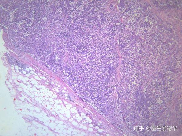 淋巴结转移灶,淋巴结内满满的全是癌细胞