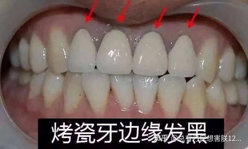 烤瓷冠边缘发黑是怎么回事?该怎么修复?