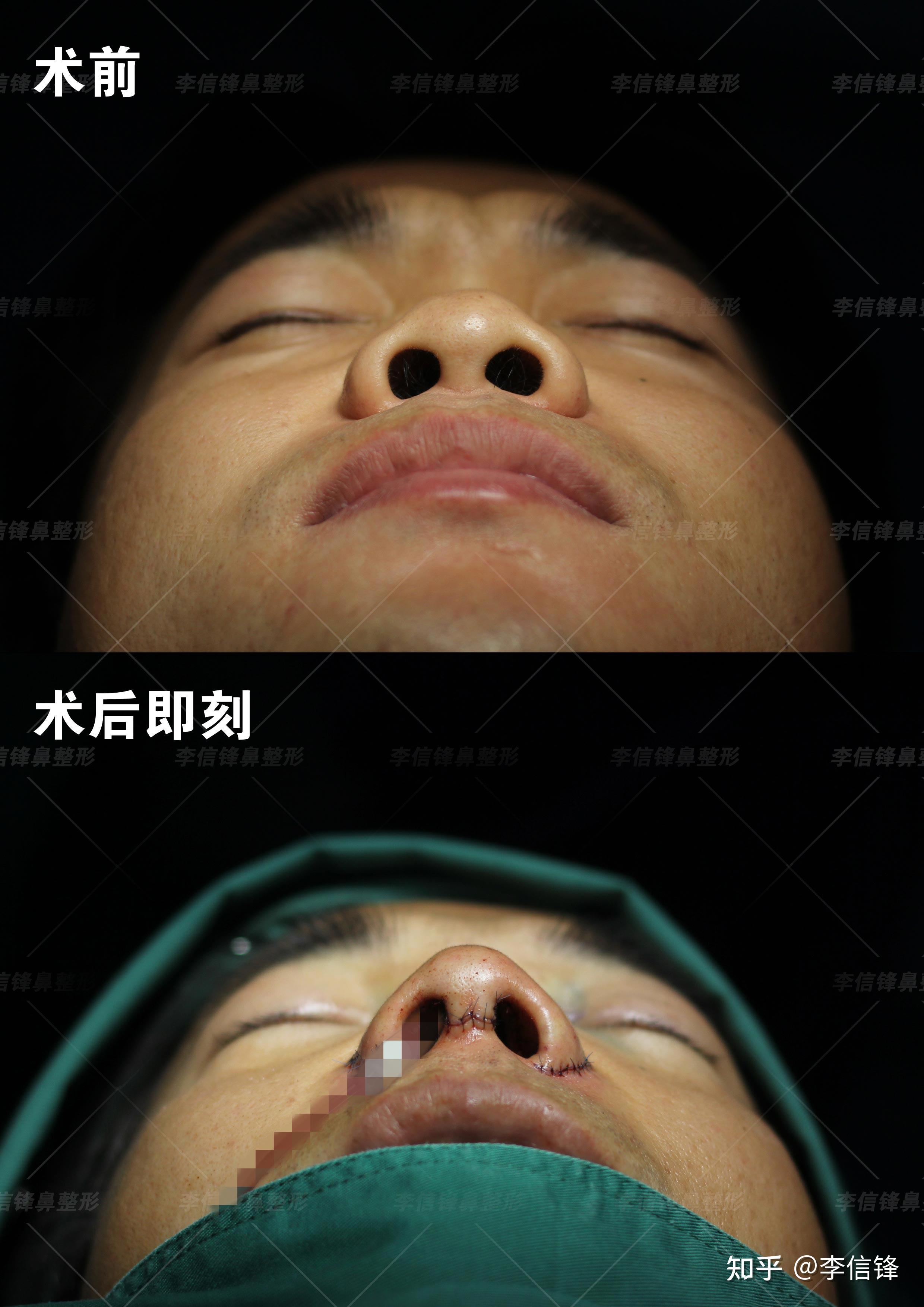 男士初鼻鼻综合案例,短塌鼻、鼻基底凹陷改善,术后即刻案例~ - 知乎