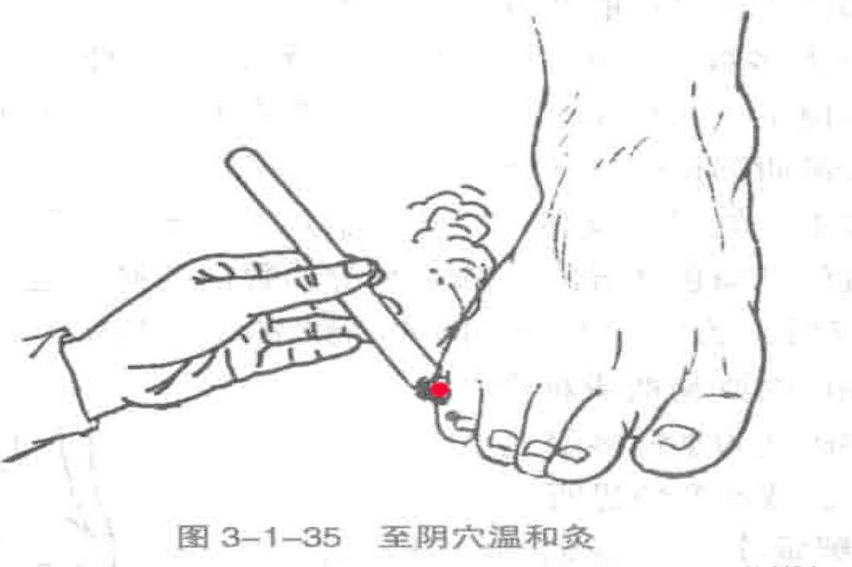 矫正胎位最简单的方法02艾灸