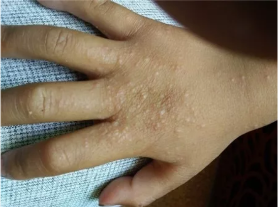 夏天到来,小朋友的皮肤出现小丘疹,这是什么病?