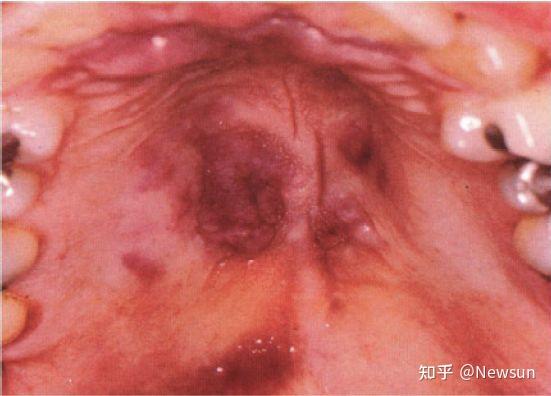 hiv感染者口腔卡波西肉瘤4.