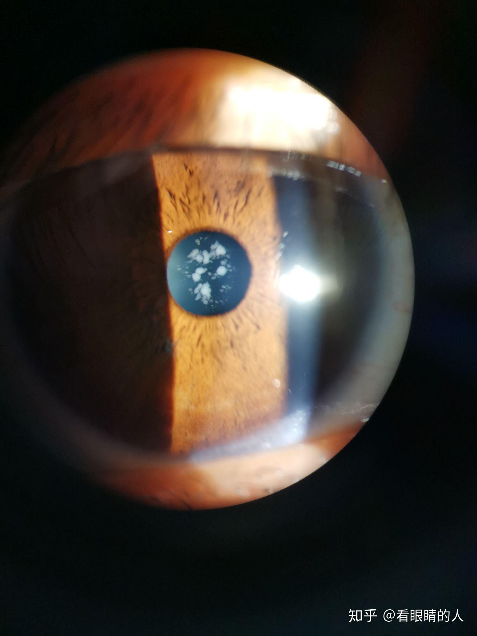 “废”透镜再利用，为角膜病患者带来希望