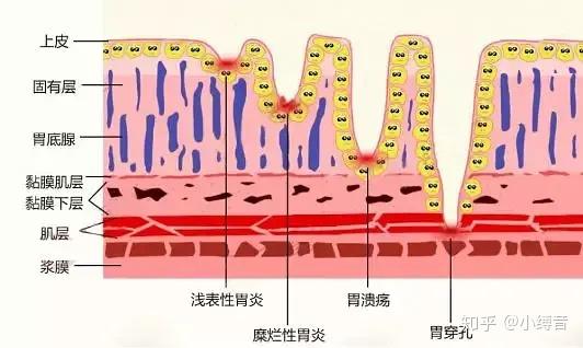 胃溃疡和胃糜烂的区别 知乎 5207