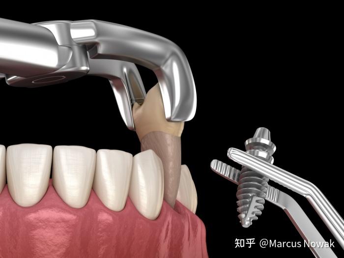 數字化種植導板,種植牙手術失敗的終結者 - 知乎