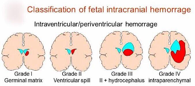 科普新生儿颅内出血