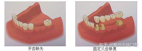 有哪些因素影响固定义齿修复