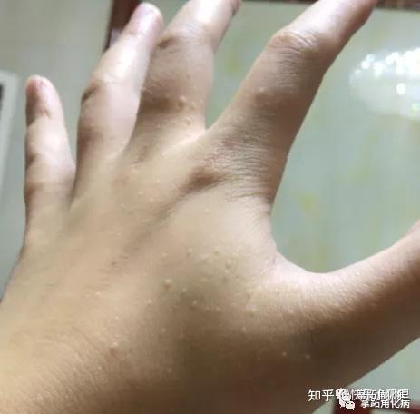 手足皮质增厚 皲裂是掌跖角化症常见症状 知乎