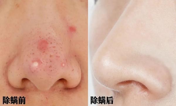 身上鼻子上挤出黄粒粒说明螨虫已过亿30秒揪出螨虫还是国货牛