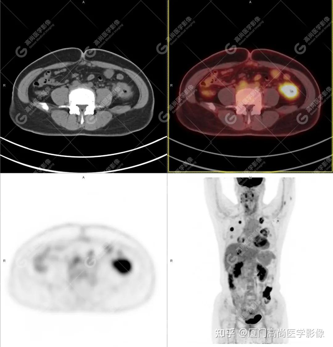 【高尚病例】平时无症状，全身PET/CT发现结肠癌多发转移 - 知乎