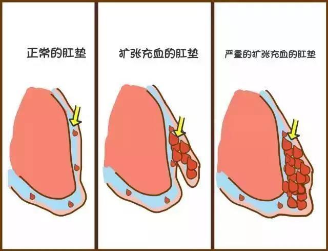 痔疮手术后需做好这4件小事切勿任意妄为