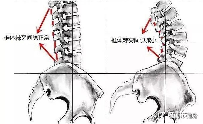 骨盆前倾图片解剖图图片