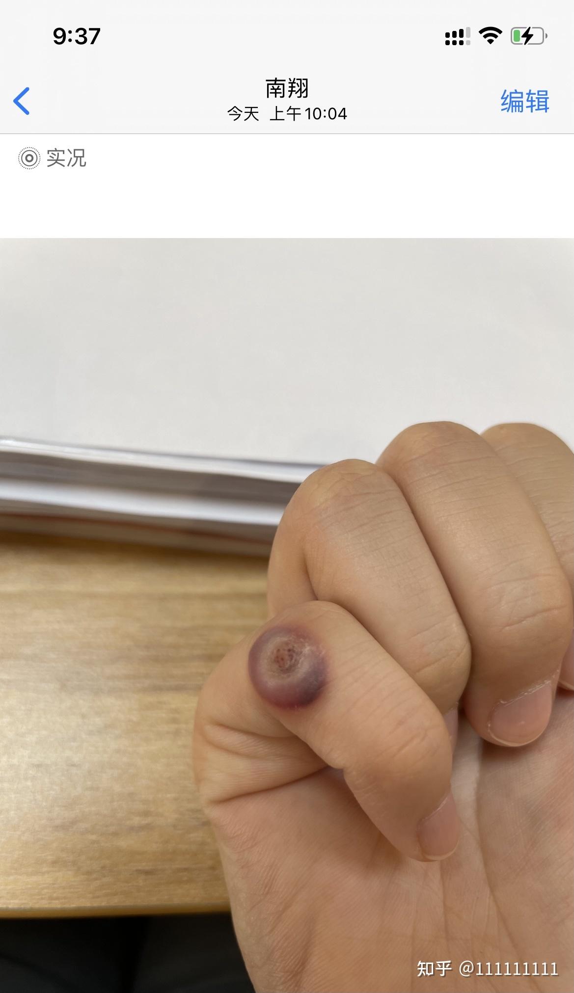 记录液氮冷冻疣过程