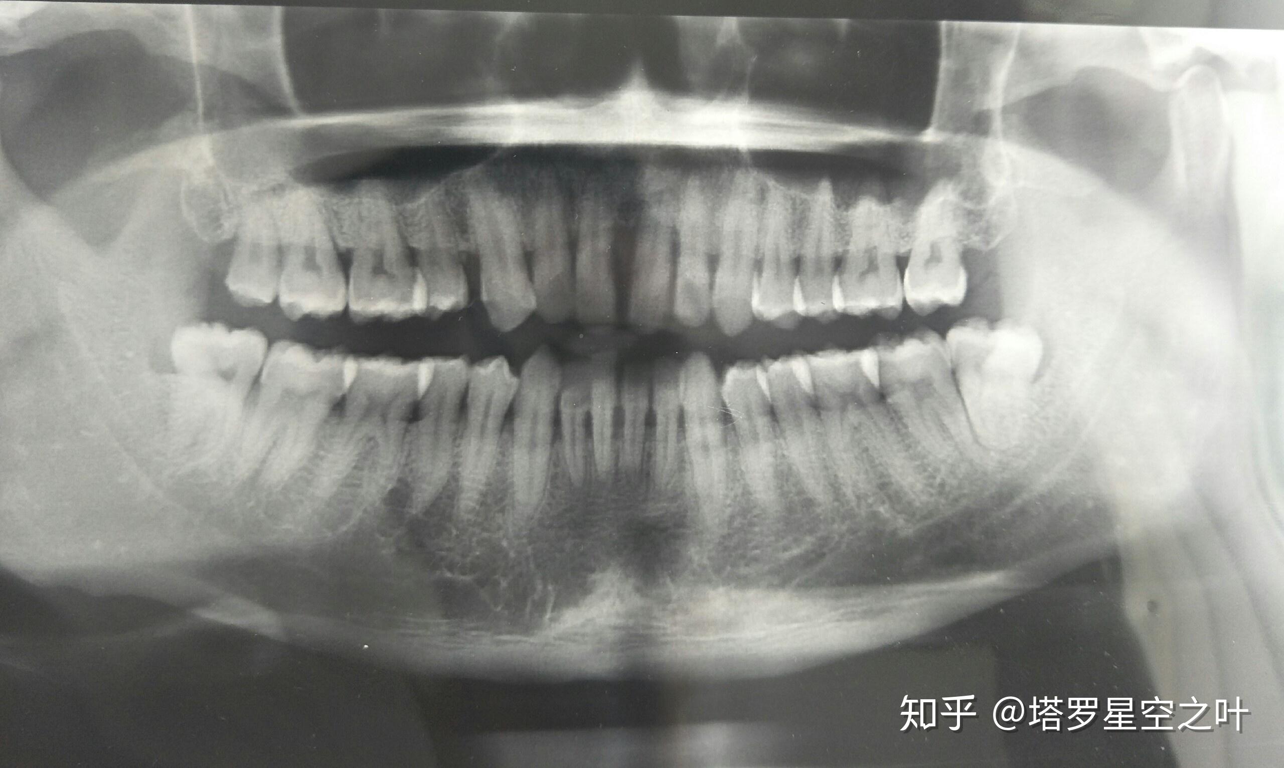 牙槽嵴顶的位置示意图-图库-五毛网