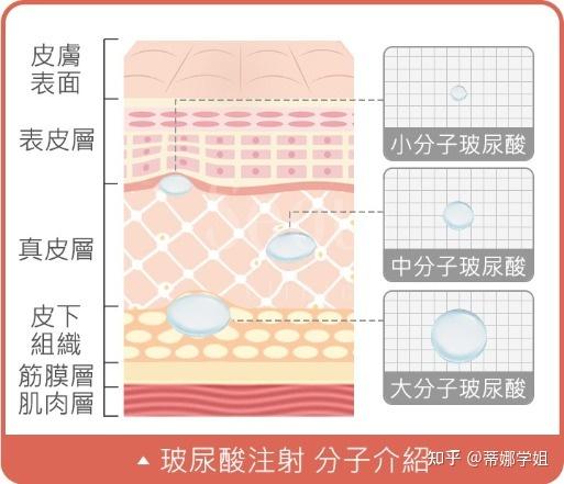 玻尿酸注射原理图片